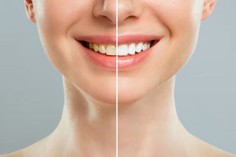 Teeth Whitening Complete Guide to Brighter Smiles and Oral Care Practices